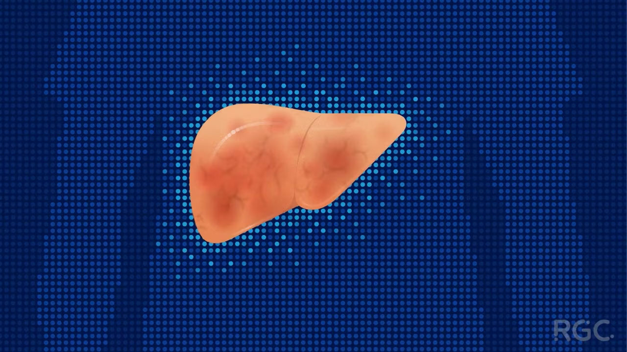 Video about how mutations in the CIDEB gene reduces risk of nonalcoholic steatohepatitis (NASH).