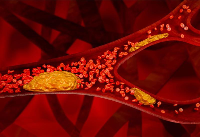 Illustration of thrombosis in a blood vessel