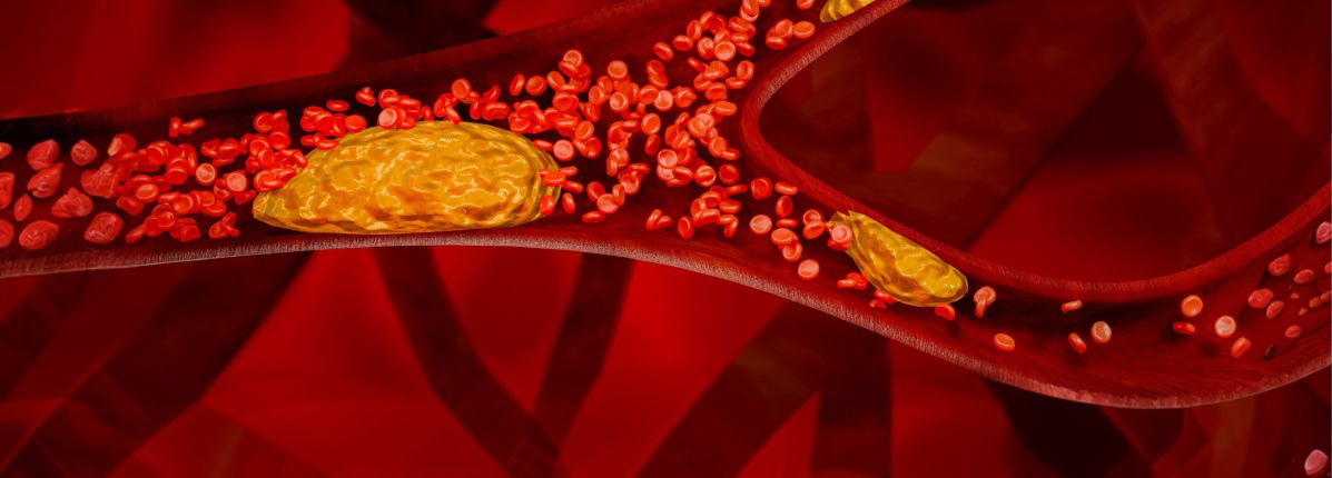 Illustration of thrombosis in a blood vessel