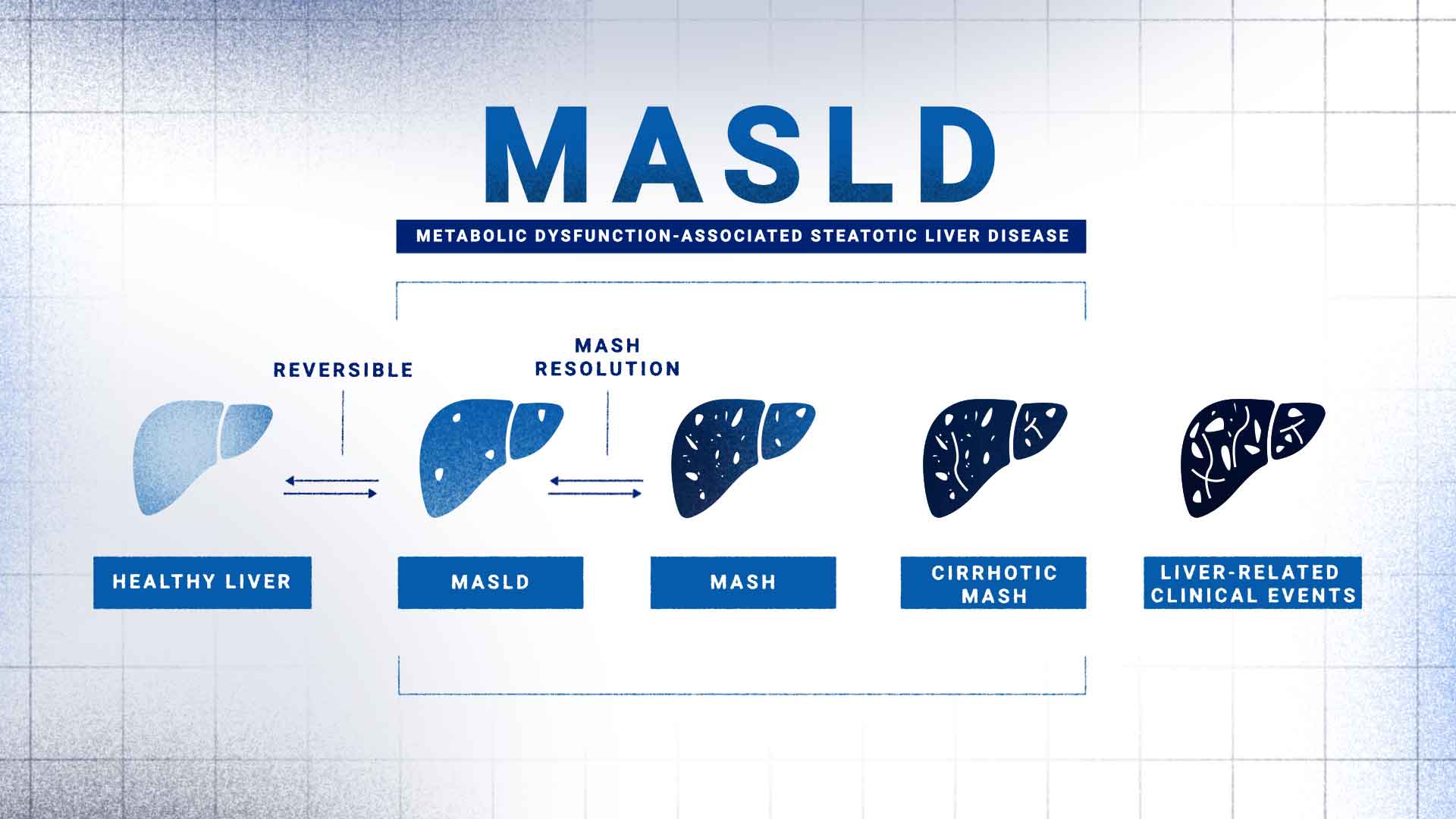  MASLD Infographic: This infographic shows the different stages of metabolic dysfunction-associated steatotic liver disease from a healthy liver to MASLD, MASH and cirrhosis.
