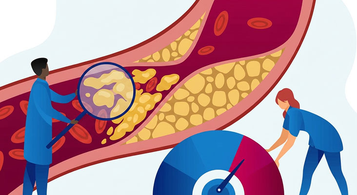 A graphic showing the impact of high LDL-C levels in the wall of a blood vessel.