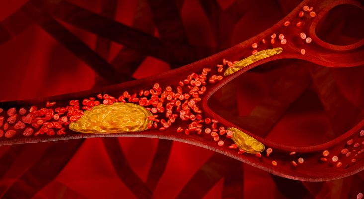 Illustration of thrombosis in a blood vessel